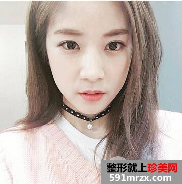 鼻尖整形多久恢复?