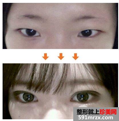 双眼皮手术恢复时间要多久？为什么她恢复得比我快？