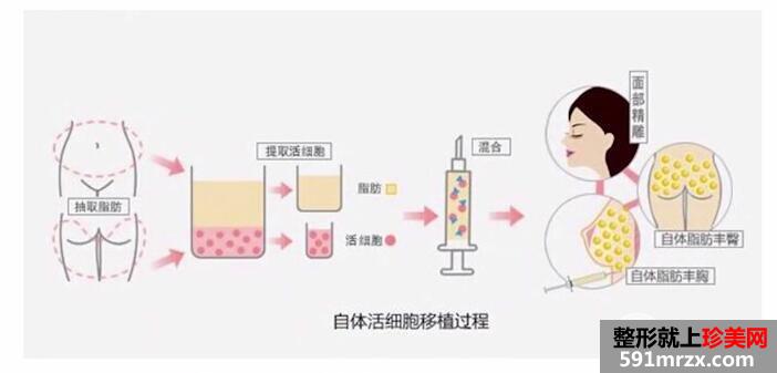 自体脂肪的存活率与哪些因素有关