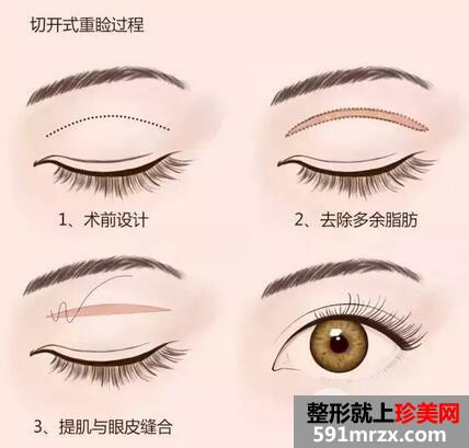 做双眼皮是埋线好还是切开好？