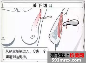 假体隆胸术手术切口优缺点有哪些?
