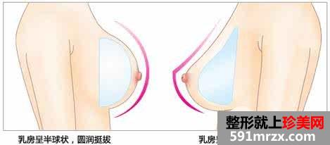 丰胸选择假体丰胸还是自体脂肪丰胸