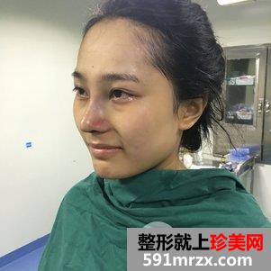 韩式芭比翘鼻恢复图片 鼻综合手术前后对比照片