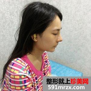 韩式芭比翘鼻恢复图片 鼻综合手术前后对比照片