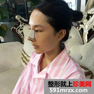 韩式芭比翘鼻恢复图片 鼻综合手术前后对比照片