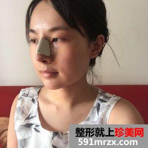 韩式芭比翘鼻恢复图片 鼻综合手术前后对比照片