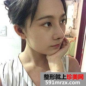 韩式芭比翘鼻恢复图片 鼻综合手术前后对比照片