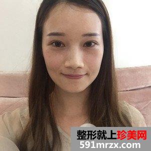 蒜头鼻整形对比照片 蒜头鼻整形恢复全过程