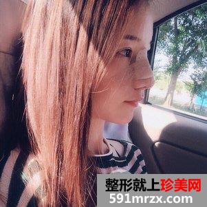 蒜头鼻整形对比照片 蒜头鼻整形恢复全过程