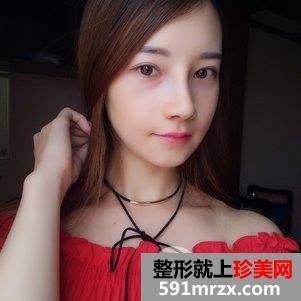 蒜头鼻整形对比照片 蒜头鼻整形恢复全过程