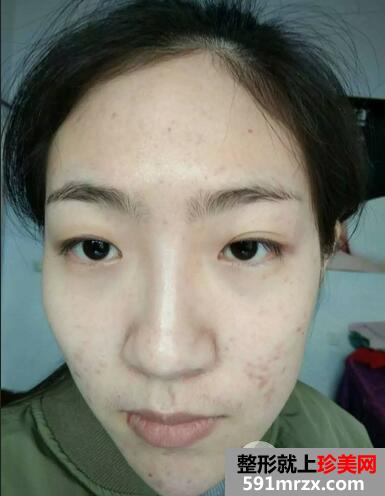 韩式开眼角手术效果好吗？双眼皮修复+开内眼角恢复分享