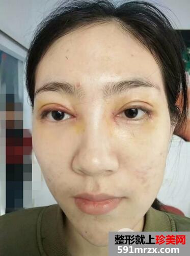 韩式开眼角手术效果好吗？双眼皮修复+开内眼角恢复分享