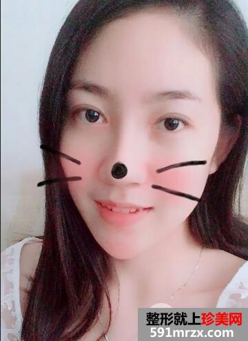韩式开眼角手术效果好吗？双眼皮修复+开内眼角恢复分享