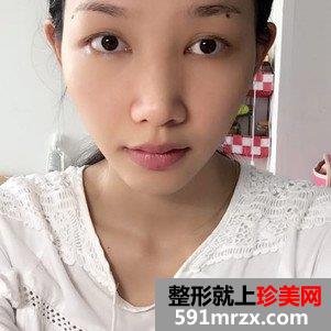垫鼻根效果怎么样？鼻综合整形前后对比及恢复过程分享