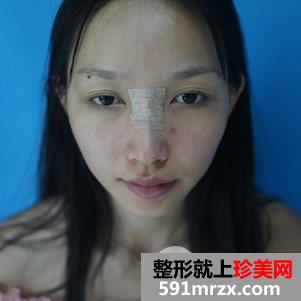 垫鼻根效果怎么样？鼻综合整形前后对比及恢复过程分享