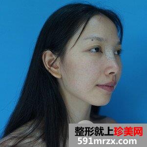 垫鼻根效果怎么样？鼻综合整形前后对比及恢复过程分享