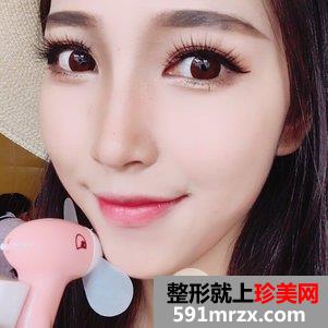 垫鼻根效果怎么样？鼻综合整形前后对比及恢复过程分享