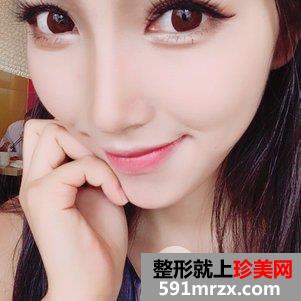 垫鼻根效果怎么样？鼻综合整形前后对比及恢复过程分享