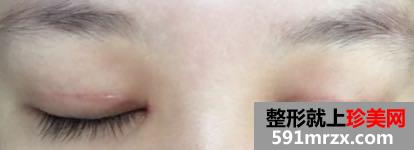 双眼皮开眼角恢复过程图，最真实案例照片