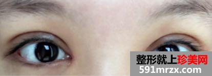 双眼皮开眼角恢复过程图，最真实案例照片
