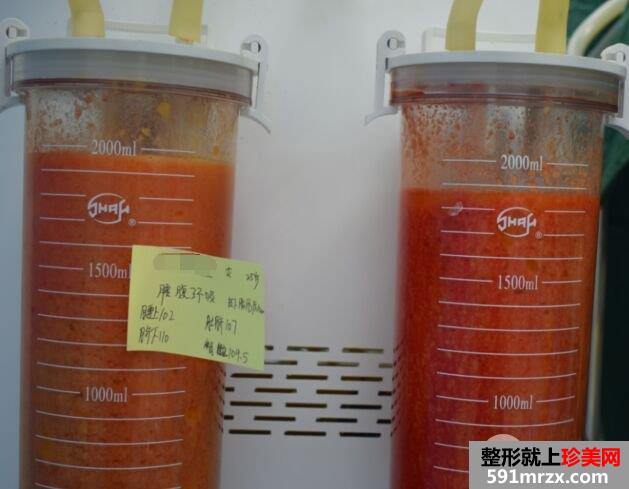 武汉米兰整形价格表|腰腹吸脂减肥真实案例前后对比照