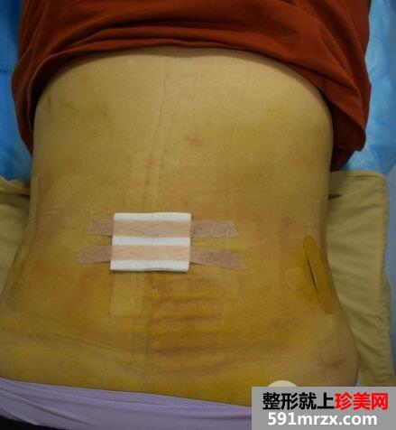 武汉米兰整形价格表|腰腹吸脂减肥真实案例前后对比照