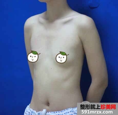 上海天大整形假体隆胸真实记录分享,火辣身材效果照片