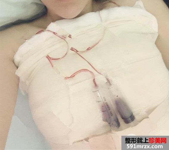上海天大整形假体隆胸真实记录分享,火辣身材效果照片