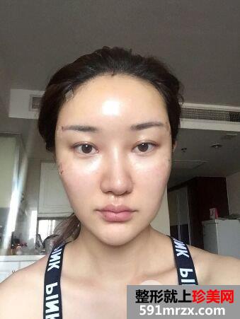 上海百达丽整形价格表,自体脂肪面部填充改善脸型效果图