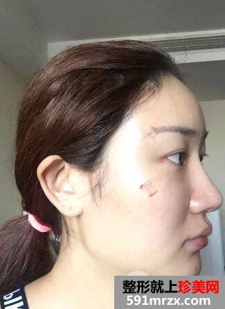 上海百达丽整形价格表,自体脂肪面部填充改善脸型效果图