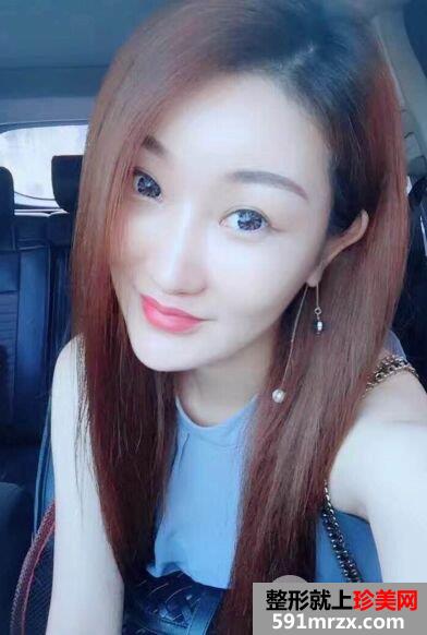上海百达丽整形价格表,自体脂肪面部填充改善脸型效果图