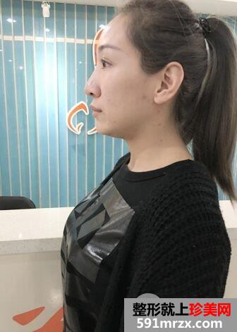 上海喜美王会勇肋软骨隆鼻修复效果图，拥有杨幂同款鼻子