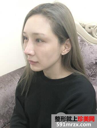 上海喜美王会勇肋软骨隆鼻修复效果图，拥有杨幂同款鼻子