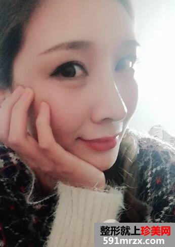上海喜美王会勇肋软骨隆鼻修复效果图，拥有杨幂同款鼻子