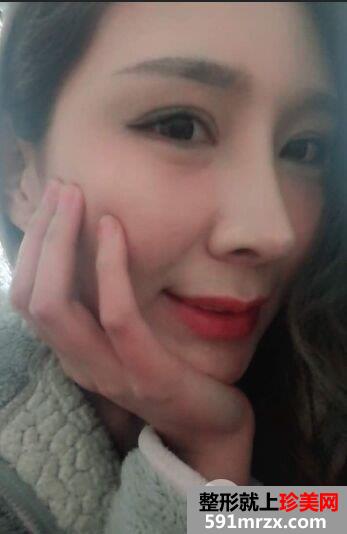 上海喜美王会勇肋软骨隆鼻修复效果图，拥有杨幂同款鼻子