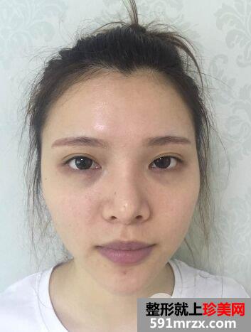 深圳仁安雅整形价格表|脂肪全脸填充个人经历分享前后对比照