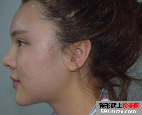 深圳仁安雅整形价格表|脂肪全脸填充个人经历分享前后对比照