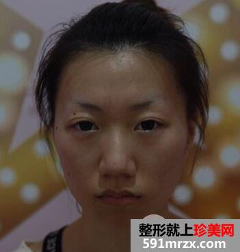 韩式肋骨隆鼻手术真实案例分享，还有更多前后对比图哦
