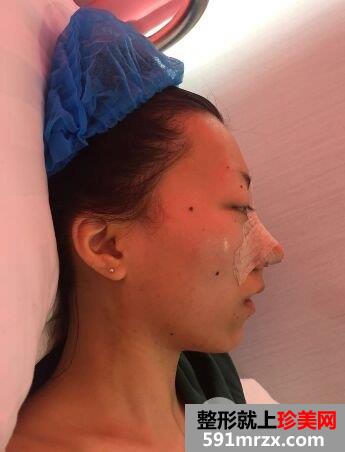 韩式肋骨隆鼻手术真实案例分享，还有更多前后对比图哦