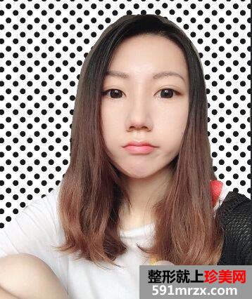 韩式肋骨隆鼻手术真实案例分享，还有更多前后对比图哦