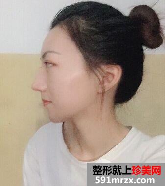 韩式肋骨隆鼻手术真实案例分享，还有更多前后对比图哦