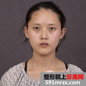 上海华美眼睛整形价格|切开双眼皮真实案例效果图