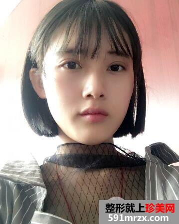 上海华美眼睛整形价格|切开双眼皮真实案例效果图