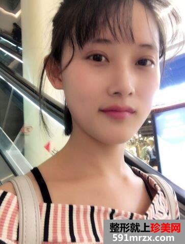 上海华美眼睛整形价格|切开双眼皮真实案例效果图