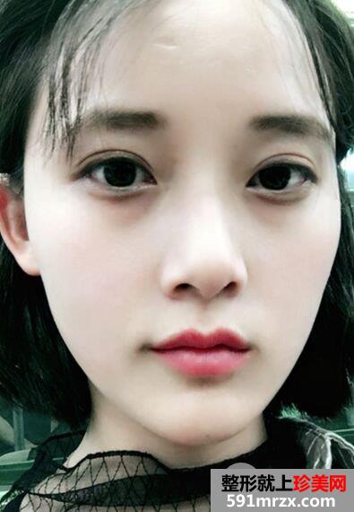 上海华美眼睛整形价格|切开双眼皮真实案例效果图