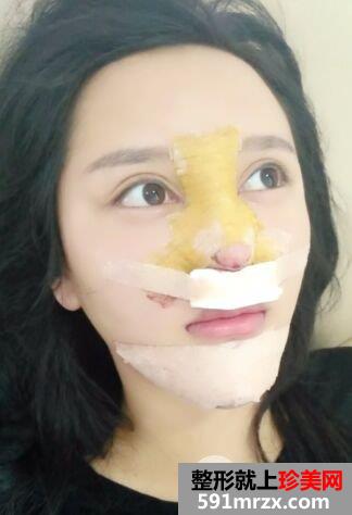 武汉喜美鼻综合整形假体垫下巴案例前后对比照