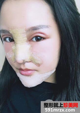 武汉喜美鼻综合整形假体垫下巴案例前后对比照