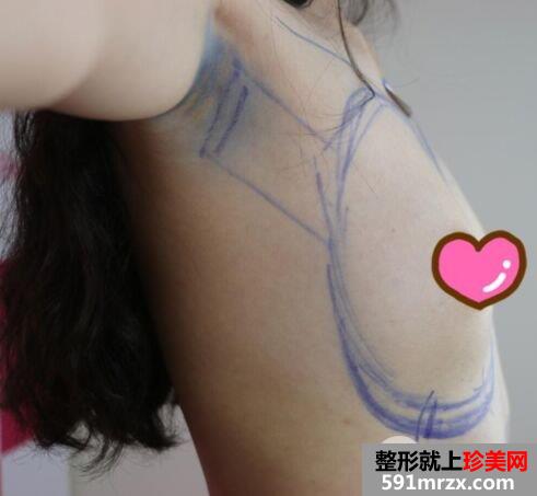深圳科美丽格胸部整形价格表|假体隆胸真实案例分享