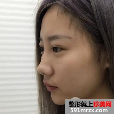鼻头缩小手术多少钱|鼻头缩小鼻综合整形真实案例对比图