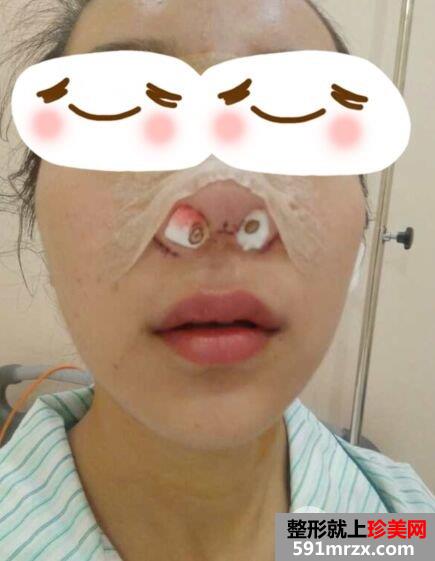 鼻头缩小手术多少钱|鼻头缩小鼻综合整形真实案例对比图